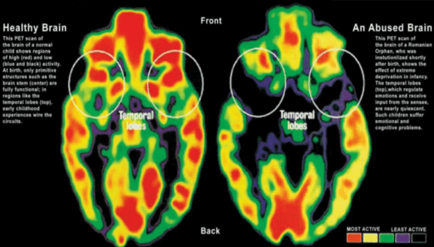 Healthy-vs-Abused-Brain-wwwunitedwayorg 1 Cardio Gram